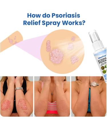 Xunnisa Meellop Herbal Psoriasis Relief Spray - Natural 30ml Soothing Treatment for All Skin - Buy Online on GoSupps.com