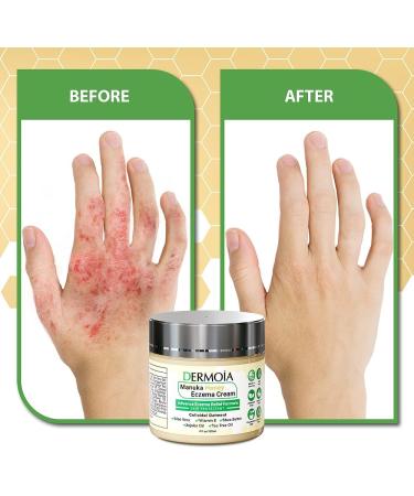 Dermoia Manuka Honey Cream for Seborrheic Dermatitis, Eczema, Psoriasis, Shingles - Soothes Dry, Irritated Skin - Face & Body Relief - 4oz - Buy Online on GoSupps.com