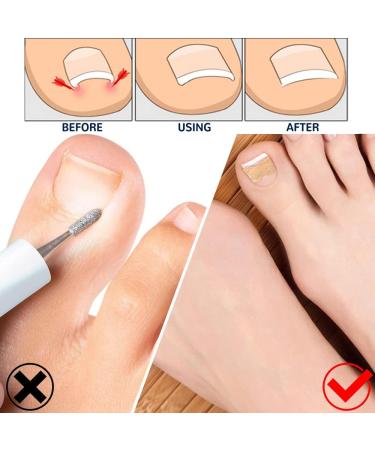 200 Pieces Ingrown Toenails Stickers Toenail Correction Patch Glue-Free Ingrown Curved Toenail Lifter Foot Care Treatment Pedicure Tool (A) - Buy Online on GoSupps.com