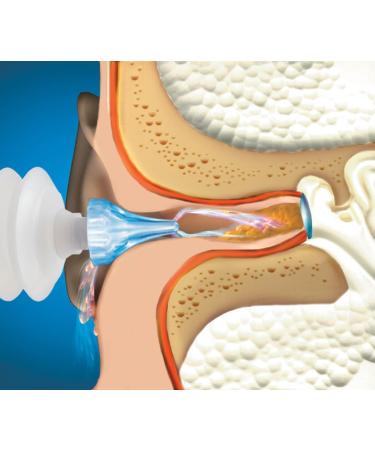 Mack's ProRinse Ear Wax Removal Syringe with Triple-Action Rinse Tip - Buy Online on GoSupps.com