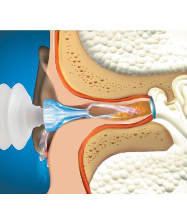 Mack's ProRinse Ear Wax Removal Syringe with Triple-Action Rinse Tip - Effective Ear Wax Removal Solution - Buy Online on GoSupps.com