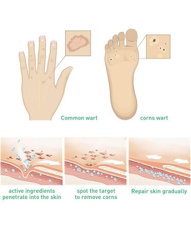 WATSKY Skin softening and foot care fluid for removing warts and corns gentle hypoallergenic formula 10 ml pack of 3 - Buy Online on GoSupps.com