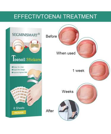 60 Pcs Toenail Correction Patch - Ingrown Toenail Corrector Tools for Perfect Pedicure - Buy Online on GoSupps.com