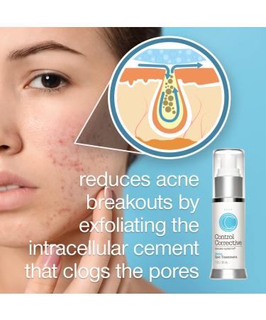 CONTROL CORRECTIVE Acne Spot Treatment Gel 2% Salicylic Acid Formula for Breakouts & Blemishes With Witch Hazel Aloe & Panthenol 1 oz Clear Skin Serum - Buy Online on GoSupps.com