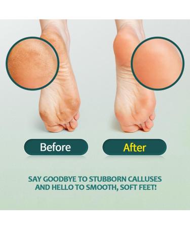 Buy Gorgellux Callus Remover Gel & Foot File Kit - Ultimate Spa Pedicure Set for Smooth Feet - Ships Internationally - Buy Online on GoSupps.com