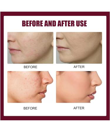 Acid Refining Serum Acid Delicate Essence 2% High-Strength Vitamin Minimises Pore Face Serum Pore Smoothing Fruit Acid Essence - Buy Online on GoSupps.com