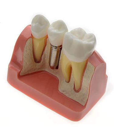 Samnuerly Dental Implant Model - 4-Way Analysis & Crown Bridge Demo for Training | International Shipping Available - Buy Online on GoSupps.com