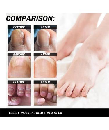 CAOQAO Nail Fix Solution Thickened Bright Nails To Get Rid Of Nail Dead Skin Fix Moisturizing Nail Nutrition Care Solution 30ml Nail Suction (B One Size) 1 count (Pack of 1) B - Buy Online on GoSupps.com
