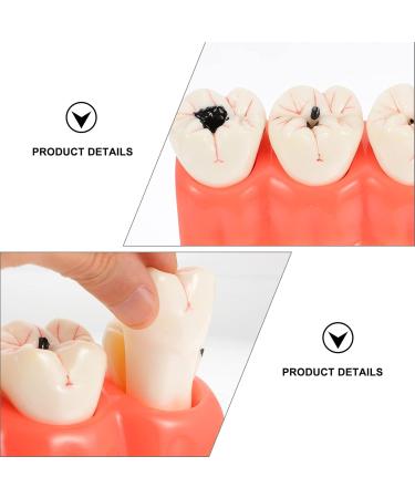 Ultechnovo Dental Recovery Tool Set - 2 Caries Tooth Models for Teaching & Demonstration | 12.5x7x6.5cm - Ideal for Dentistry Education - Buy Online on GoSupps.com