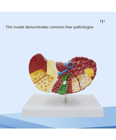 Liver Damage ical Model Liver Pathology Models Teaching Aids - 22.5 * 17 * 16CM - Buy Online on GoSupps.com