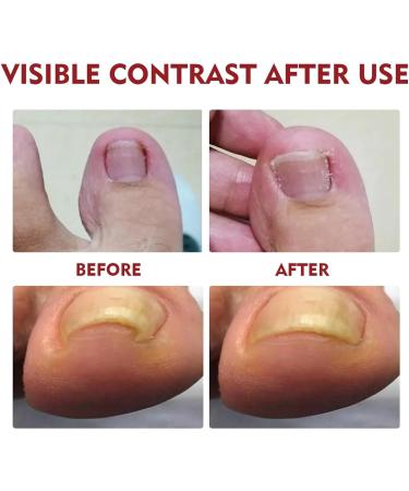 Ingrown Toenail Treatment Oil - 2PCS | Anti-Paronychia Relief & Ingrown Toenail Correction Drops - Buy Online on GoSupps.com