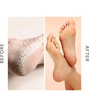 Vitali-Chi Hand & Foot Cream | for Deep Cracked Heels Fungal Conditions and Verrucae - 100ml - Buy Online on GoSupps.com