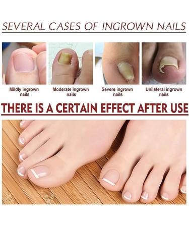 (100% Effective) KYOSK 10ml German Anti Paronychia Relief Oil Anti Paronychia Relief Oil Treatment Repair Paronychia Improve Toenail Health (2pcs) - Buy Online on GoSupps.com