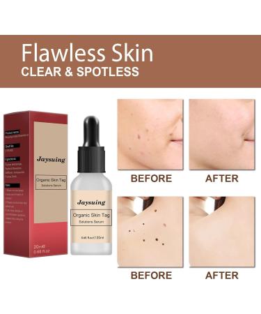  DRYIC Nevus Lotion for removing black spots from moles Cream for removing black spots - Buy Online on GoSupps.com