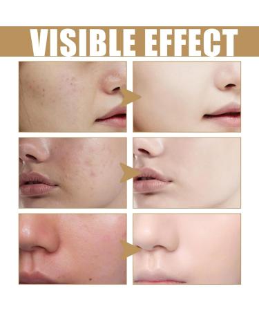 Azelaic Acid Suspension 10% Face Serum Face Serum for Women Azelaic Acid Serum Cream Hydrating Face Cream Face Skin Care Beauty with Niacinamide & Vitamin C Facial Moisturiser Skincare Serum - Buy Online on GoSupps.com