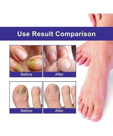 ZERZK 10ml Repair Nail Fungus Treatments Essence Foot Care Nails AntiInfection Toe Fungus Serum Onychomycosis Removal Gel - Buy Online on GoSupps.com