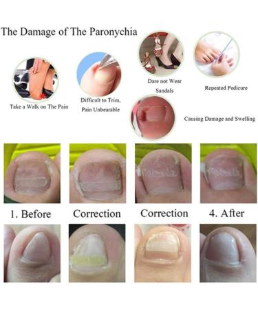 Toenail Tool 6 in 1 Ingrown Toe Nail Fixer Pedicure Toenail Recover Nail Foot Care Kit Ingrown Toenail Corrector for Men Women(24pcs) - Buy Online on GoSupps.com