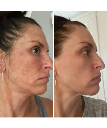 Jessner Solution Acid Peel 100% 1oz. 30ml (Level 2 pH 1.9) - Exfoliating (FREE Neutralizer 100ml) - Buy Online on GoSupps.com