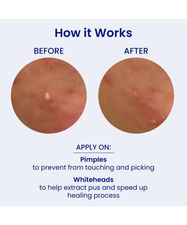 FaceTory Spot Fighter Acne Blemish Patches (150 Count) | Hydrocolloid Day & Night Patches for Acne Spot Treatment - 2 Sizes | AM & PM Assortment - Buy Online on GoSupps.com