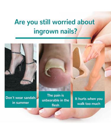 Ingrown Toenail Correction Stickers - Professional Elastic Patch for Curved Toenails - 50PCS - Buy Online on GoSupps.com