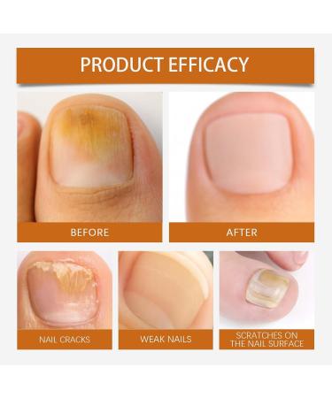 Nail Recovery SprayMoisturizing Natural Nail Recovery Spray Deep Cleansing Care Travel Size For Damaged Nails Women Men Adults Elderly - Buy Online on GoSupps.com