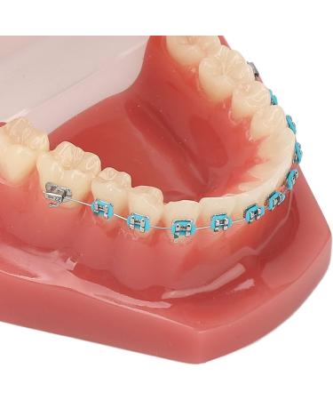 Typodont Orthodontic Tooth Model (28 Teeth) - Realistic Crowded Teeth & Malocclusion Representation for Dental Education & Practice - Buy Online on GoSupps.com