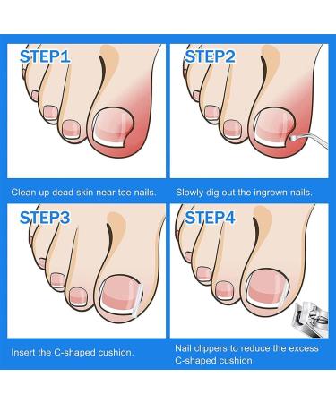 Toe Nail Correction Tools Set | Ingrown Toenail Fix Pedicure Patch & Paronychia Corrector - Buy Online on GoSupps.com