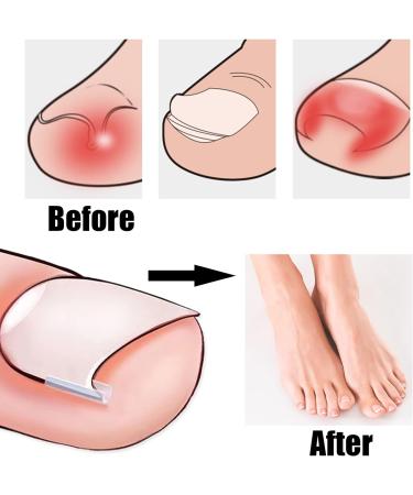 52 Pcs Ingrown Toenail Correction Strips Brace Kit Ingrown Toenail Corrector Toenail Correction Patches Ingrown Toenail Treatment Toenail Straightener Strips with Nail Clipper for Women Men Foot Care - Buy Online on GoSupps.com
