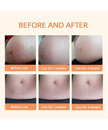 Optimal Oil Skin Regenerate Oil Body Oil Skin Care Collagen Boost Firming & Lifting Skincare Oil Stretch Marks Removal Stretch Mark Oil Improves the Appearance of Stretch Marks Oil for Scars 125ml - Buy Online on GoSupps.com