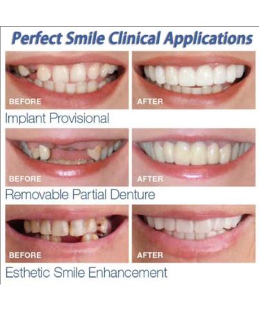 Batlam Snap-On Veneers - 4 Pairs Artificial Teeth for Instant Smile | Fake Snap-in Teeth for Men & Women - Buy Online on GoSupps.com