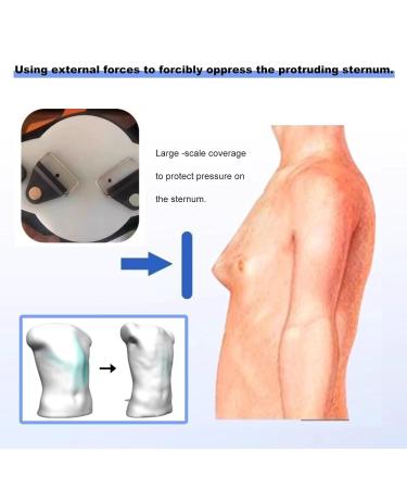 Pectus Carinatum Orthosis Brace - Sternum Protrusion Corrector Pigeon Chest Support for Adult Skin-Friendly and Breathable Will Not Move Freely Adjust the Size (Adult) - Buy Online on GoSupps.com