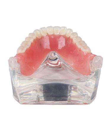 Dental Teeth Model - Lower Removable Overdenture with 2 Implants | Dentist Assistant Supplies - International Shipping - Buy Online on GoSupps.com