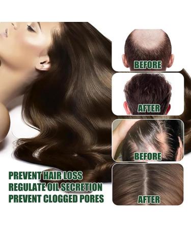 Lidoria Ginger Anti Hair Loss Lidoria Hair Growth Oil Ginger Anti Hair Loss 7 Days Oil 35ml Natural Ginger Hair Growth Serum Repair Damaged Hair Ginger Hair Growth Oil for Women & Men (2Pcs) - Buy Online on GoSupps.com