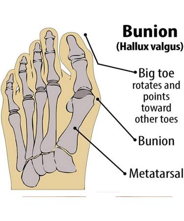 Hallux Valgus Foot Toe Alignment Socks - Small 2pair - Buy Online on GoSupps.com