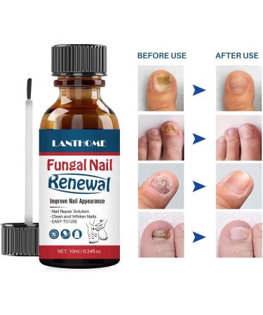 Fungal Nail Treatment Kills Toe Nail Fungus Dead Liquid HIGHLY EFFECTIVE Toenail Finger Nail Anti Fugal Treatment clear - Buy Online on GoSupps.com