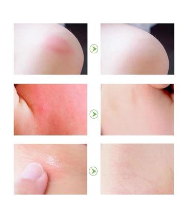 Bosuya Anti Itch Stick & Baimiss Bug Bite Relief Stick Set (6pcs) - Cool and Comfortable, Suitable for All Skin Types - Buy Online on GoSupps.com