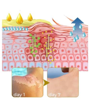 GFOUK Acanthosis Nigricans Dark Spot Peeling Oil - 1pcs - Buy Online on GoSupps.com