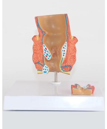 Life Size Human Rectal Hemorrhoid Lesion Model PVC Human Anorectal Pathology Model Demonstration Teaching Model