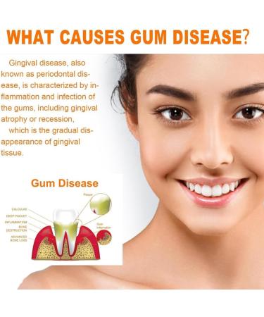 Buy Gum Repair Treatment Ampoules - Oral Repair Serum for Tartar Removal | 2 Boxes of Effective Gum Repair and Tooth Whitening Essence - Buy Online on GoSupps.com