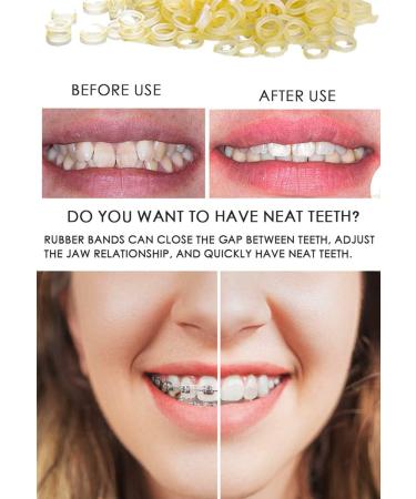 500 pcs Monkey 3/8 Orthodontic Elastic Bands for Braces - Latex Rubber Bands 3/8 Inch - Buy Online on GoSupps.com