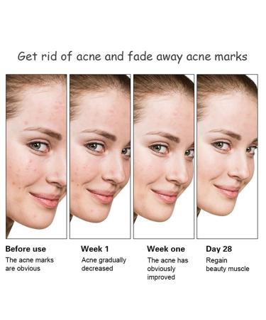 AICHUN BEAUTY Anti-Acne Facial Serum with Aloe Vera & Salicylic Acid 30ml for Damaged Skin Repair | International Shipping Available - Buy Online on GoSupps.com