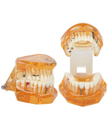 Standard Tooth Model - Removable Dental Teaching Materials for Kids & Adults | Typodont Demonstration Model - Buy Online on GoSupps.com