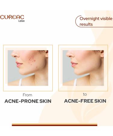 Calamine Acne Drying Lotion Overnight Results for Teens & Adults-70 ml - Buy Online on GoSupps.com