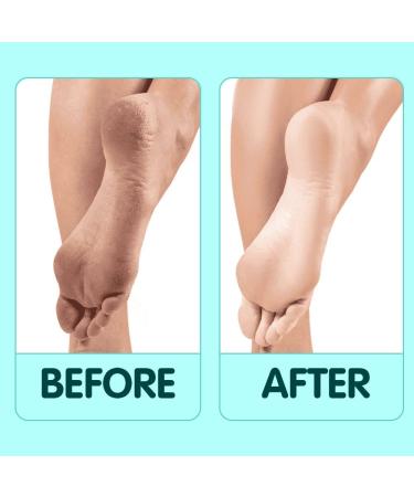 NOVAL 4-in-1 Foot Pumice Stone Set - Callus Remover & Exfoliator Tool for Pedicure (Pack of 4) - Buy Online on GoSupps.com