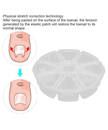 Nail Correction Sticker - Professional Ingrown Toenail Treatment & Paronychia Smoothing Patches for Perfect Toenails - Buy Online on GoSupps.com