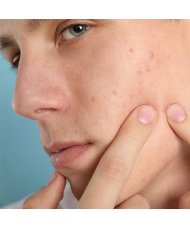 Buy Men's Anti-Acne Serum - Fast International Shipping | Clear Skin Solutions - Buy Online on GoSupps.com