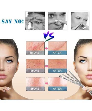4PCS Blackhead Remover Tool Set for Acne, Comedone, Pimples, Spot, and Zit Extraction - Buy Online on GoSupps.com