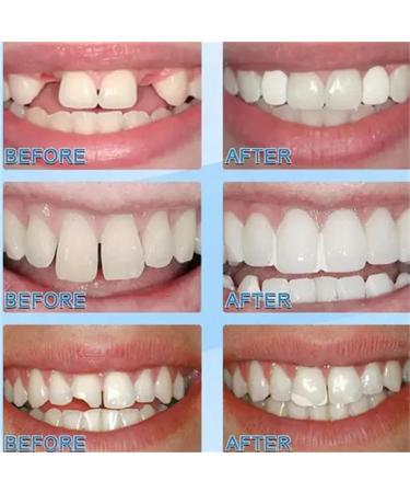 Browsluv DIY Tooth Repair Kit - 2023's Best Temporary & Permanent Tooth Filling Solution | Fix Broken Teeth at Home in Minutes (1 PC) - Buy Online on GoSupps.com
