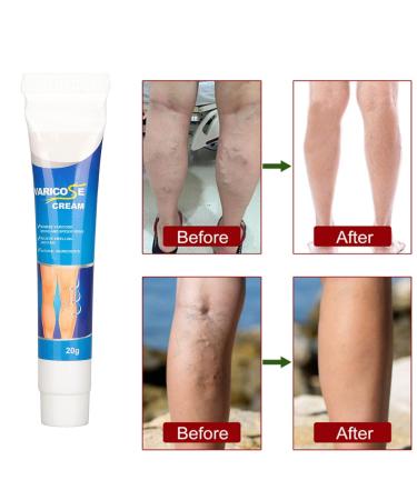 Varicose Veins Cream | Eliminate Spider Veins & Soothing Treatment - International Shipping - Buy Online on GoSupps.com