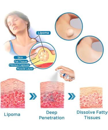 LipoOut Lipomheilung Reduction Spray Instant LumpFree Lipoma Removal Spray LumpFree Lipoma Removal Spray 50ml (4pcs) - Buy Online on GoSupps.com